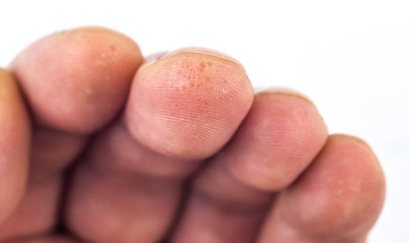 Tìm hiểu về bệnh tổ đỉa ở trẻ sơ sinh 1