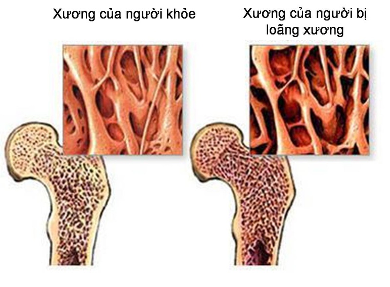 Tìm hiểu về chỉ số loãng xương