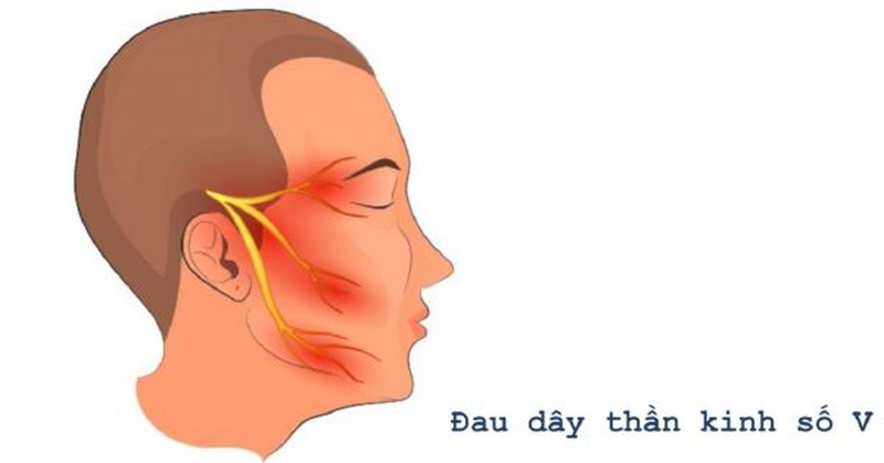Tìm hiểu về đau dây thần kinh số 5-2