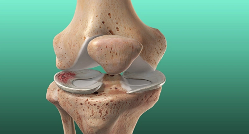 Tìm hiểu về rách sụn chêm đầu gối 1