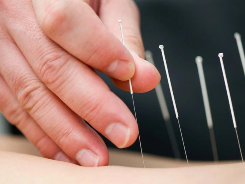 Không khuyến khích châm cứu huyệt nhân nghênh nếu không phải trường hợp bất đắc dĩ 