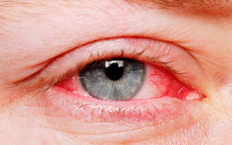 Bệnh nhân bị xuất huyết dưới mắt được chẩn đoán khi toàn bộ hoặc một phần lòng trắng của mắt đột nhiên bị nhuộm đỏ màu máu