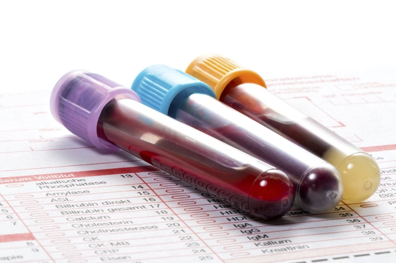 Tìm hiểu xét nghiệm tổng phân tích tế bào máu ngoại vi