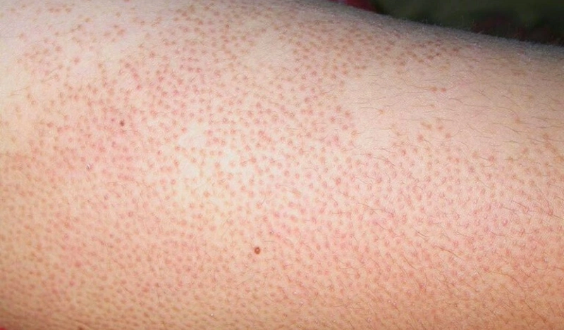 Nguyên nh-n viêm lỗ ch-n lông ở bắp ch-n