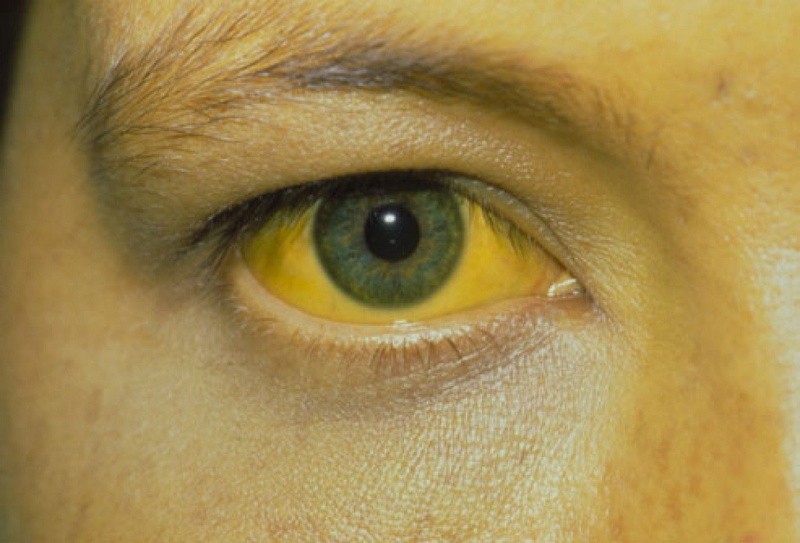 10 dấu hiệu cảnh báo tình trạng bất ổn của mắt bạn nên biết 3