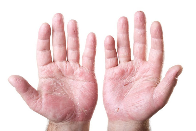 Dị ứng bàn tay là dấu hiệu da bàn tay bị sưng, ngứa hoặc lóc da
