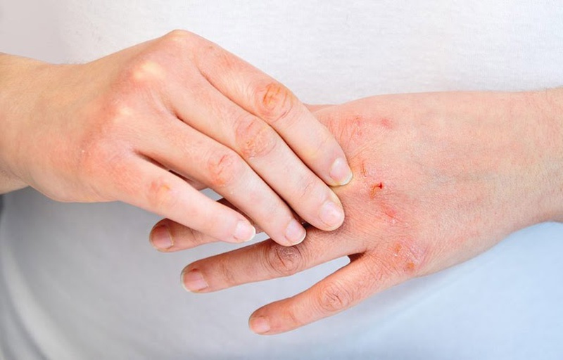 Dị ứng da bàn tay có thể giảm bớt khi điều trị bằng các nguyên liệu thiên nhiên