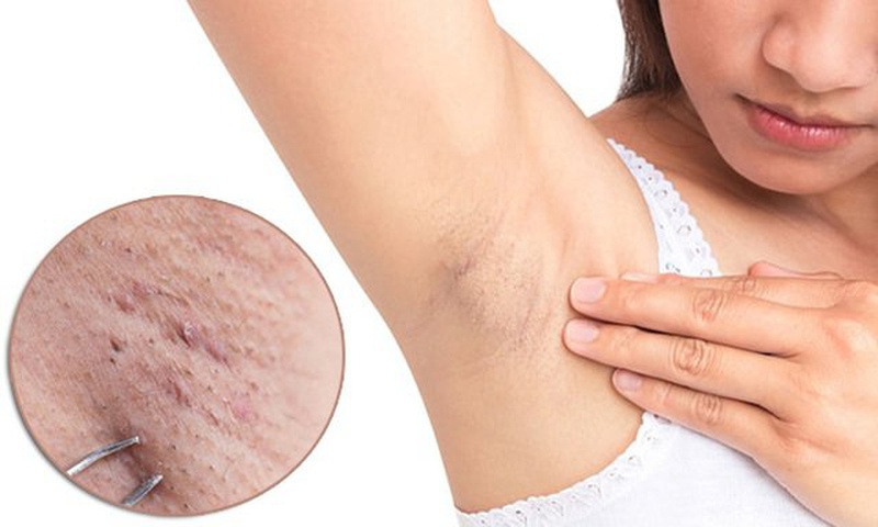 Chăm sóc vùng nách kĩ càng và đều đặn sẽ hạn chế tốt tình trạng lông nách mọc đôi