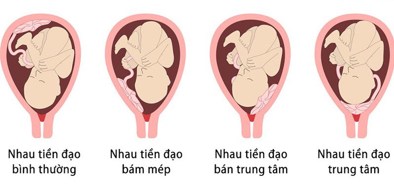 Tình trạng nhau bám mặt trước nên nằm như thế nào? 2