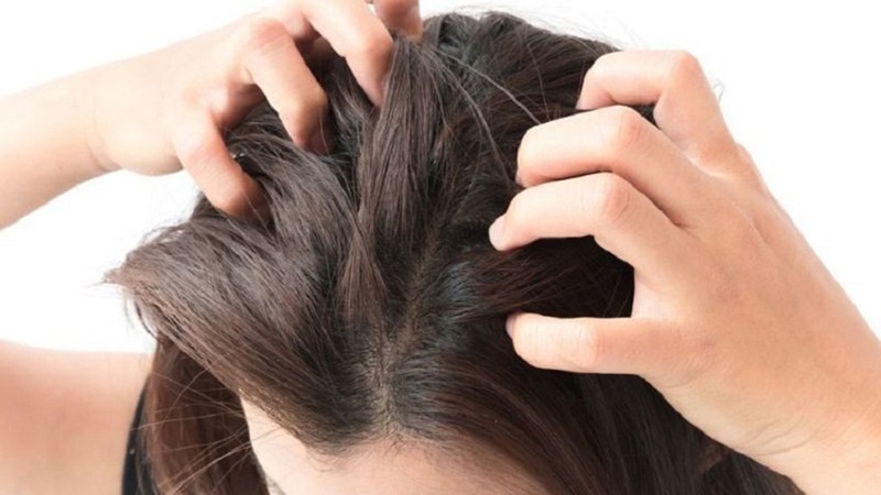 Tình trạng rụng tóc nhiều ở nữ tuổi 20 - Nguyên nhân và cách điều trị 2