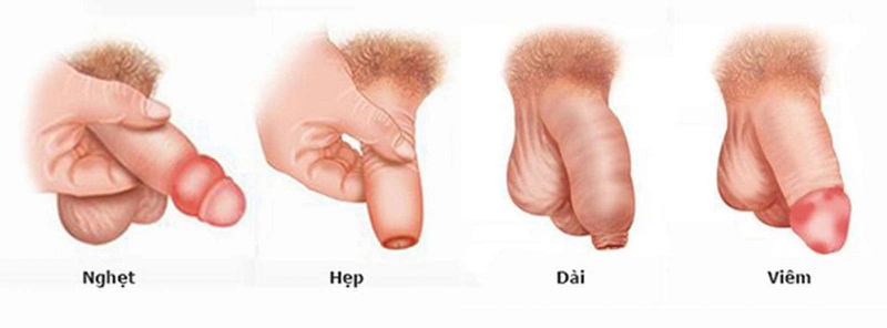 Dấu hiệu viêm bao quy đầu dễ nhận biết
