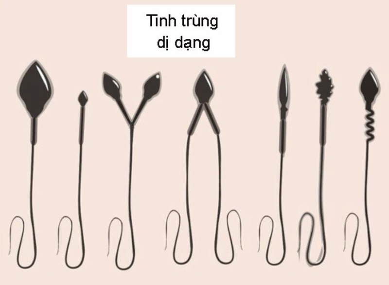 Hầu hết nam giới đều có tinh trùng dị dạng