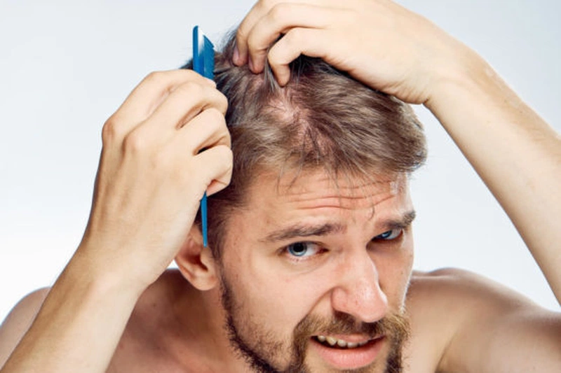 Cách trị gàu hiệu quả cho nam và một số lưu ý 2