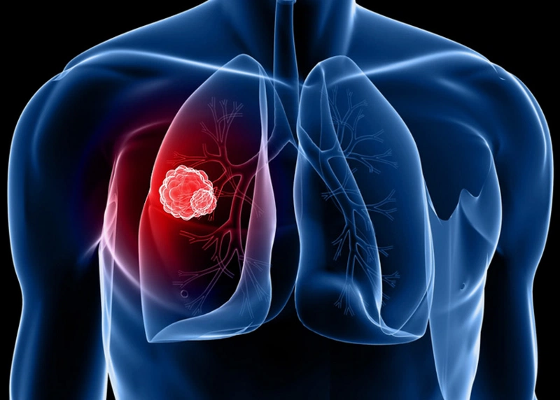 Tỏi đen trị ung thư phổi rất tốt