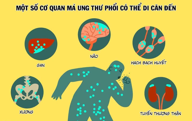 Tổng hợp các loại thuốc chữa ung thư phổi giai đoạn cuối 1