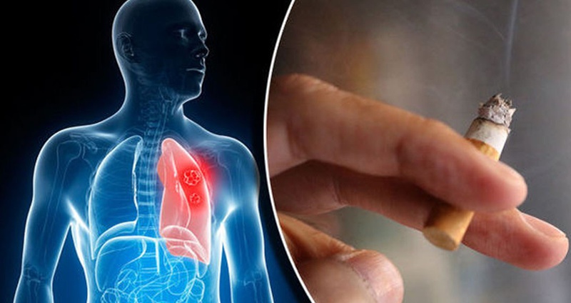 Tổng hợp các thông tin hữu ích về tầm soát ung thư phổi