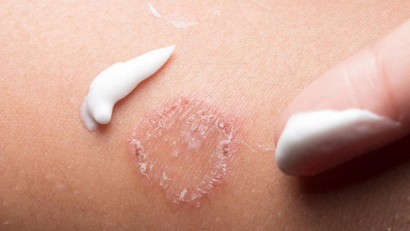 Điều trị bệnh hắc lào nặng bằng thuốc Tây bôi ngoài da