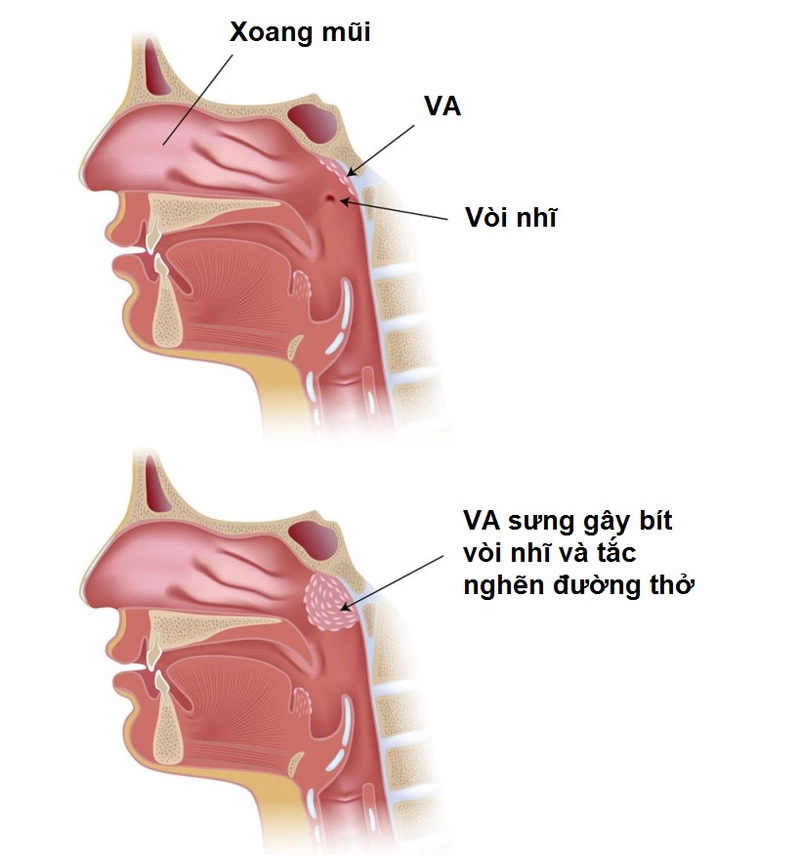 Tổng hợp những điều cần biết về viêm VA quá phát ở trẻ nhỏ 2
