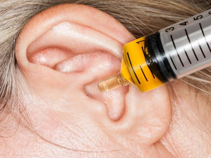 Tổng quan phác đồ điều trị viêm tai giữa mạn tính và cấp tính