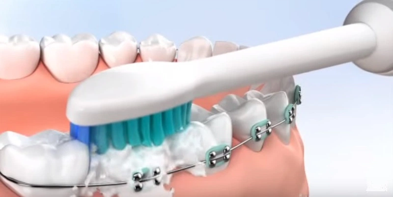 Bàn chải cho người niềng răng cần có lông mềm để không làm tổn thương nướu