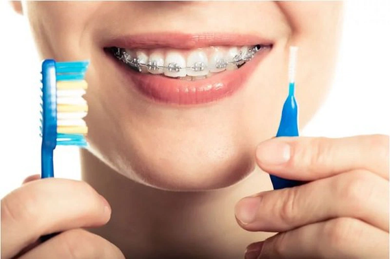 Bàn chải cho người niềng răng hiện nay rất đa dạng