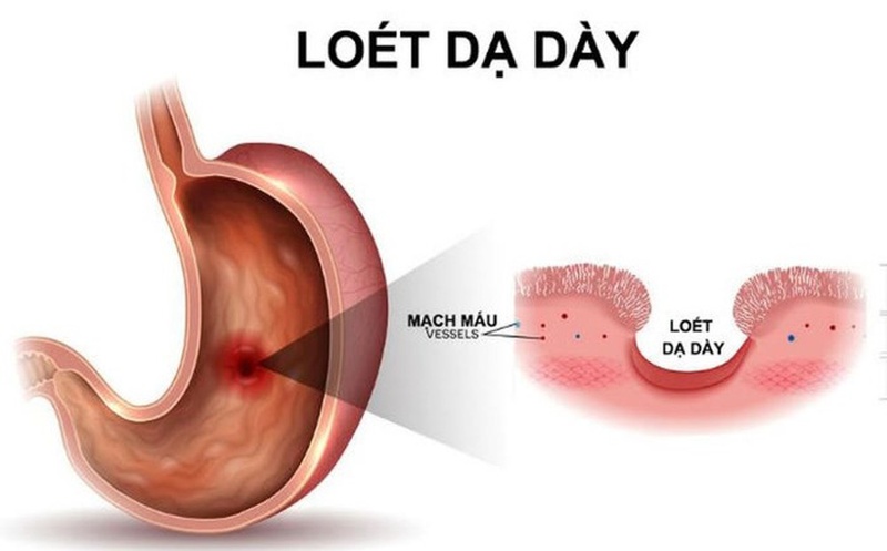 Top 3 bệnh thường gặp của dân văn phòng 2