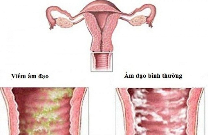 Nhiễm nấm Canada gây nhiễm trùng nấm men