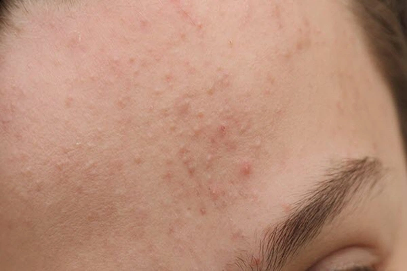 Các tiêu chí lựa chọn kem trị mụn ẩn