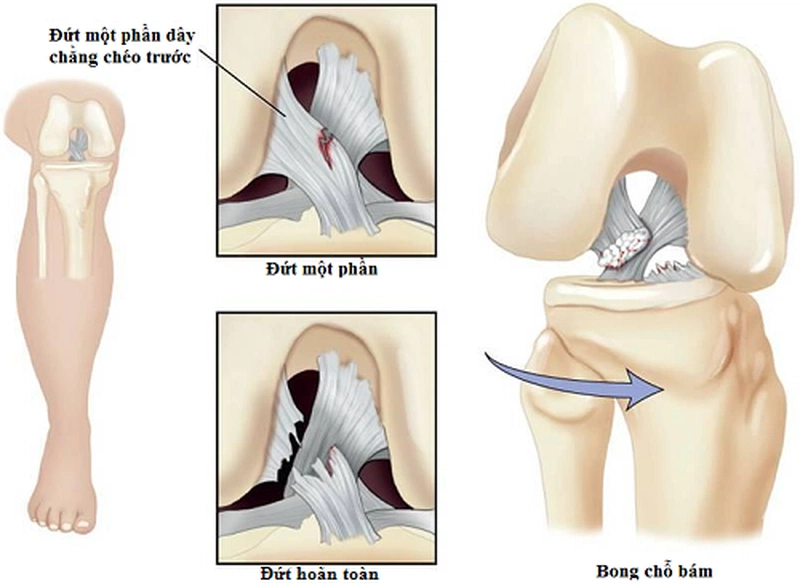 Đa phần các trường hợp đứt bán phần dây chằng chéo trước xảy ra thông qua cơ chế không tiếp xúc