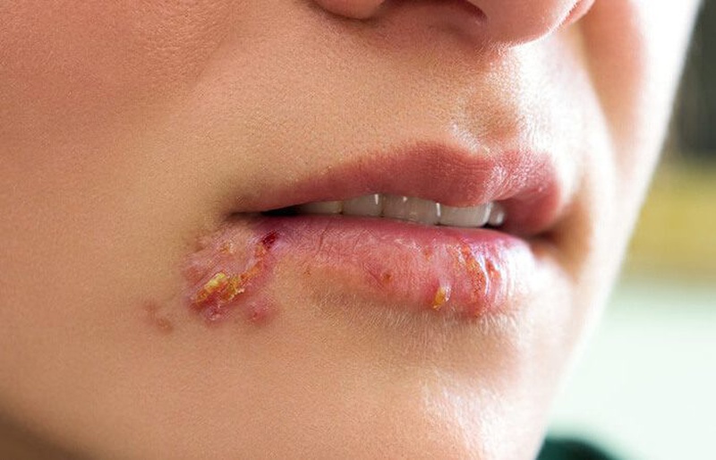 Top 5 bệnh thường gặp ở miệng nguy hiểm bạn cần cảnh giác