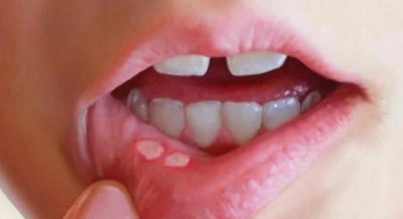 Top 5 bệnh thường gặp ở miệng nguy hiểm bạn cần cảnh giác