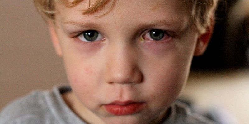 Top 5 bệnh về mắt thường gặp ở trẻ và cách phòng chống 2