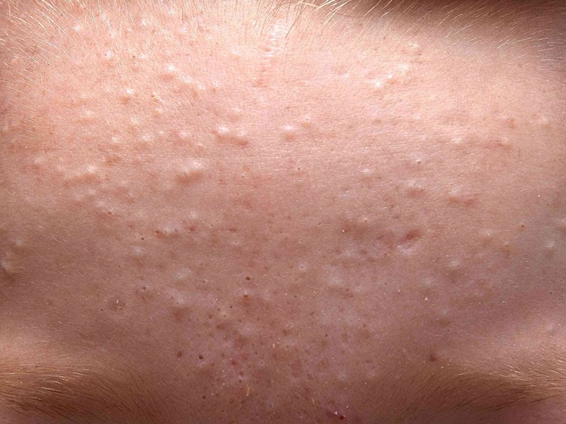 cách đẩy mụn ẩn an toàn tại nhà