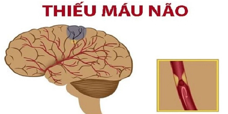 Top 6 cây thuốc trị thiếu máu não hiệu quả 1