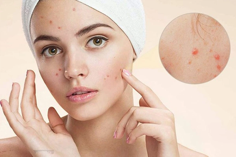 Top kem chống nắng “ cứu tinh” đến từ nhà innisfree cho làn da dầu mụn khó chiều