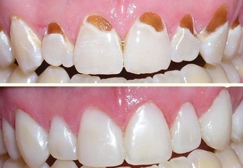 Phương pháp trám mòn cổ chân răng có công dụng giúp người bệnh kịp thời bảo vệ được mô răng đang bị mòn