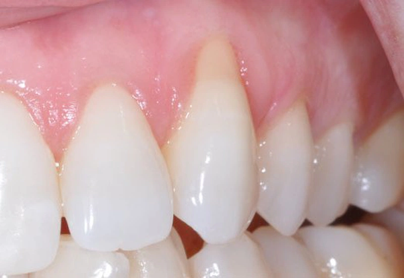 Việc lựa chọn phương pháp điều trị nào sẽ phụ thuộc vào mức độ tổn thương của chân răng