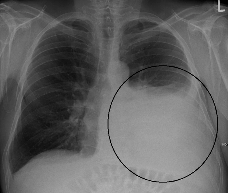 Tràn dịch màng phổi do lao: Triệu chứng và cách điều trị 1