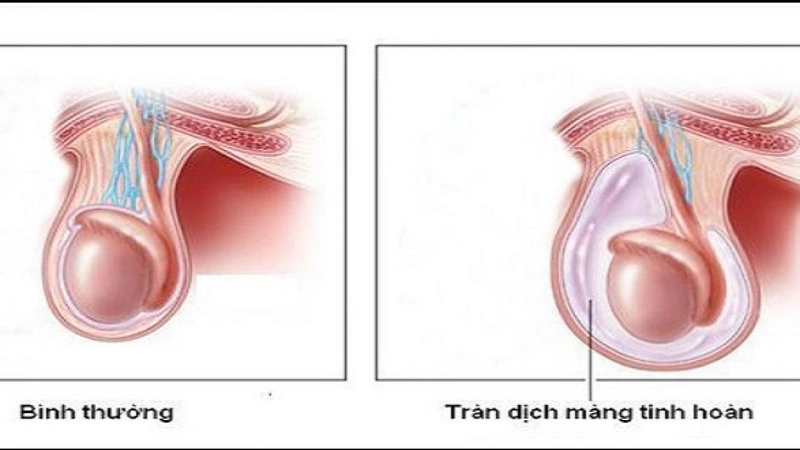 Tràn dịch màng tinh hoàn bao lâu thì khỏi? 2