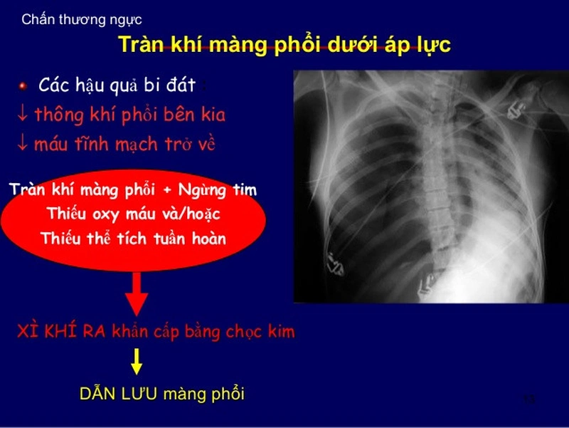 Tràn khí màng phổi áp lực là gì, biểu hiện & phương pháp chẩn đoán bệnh 1