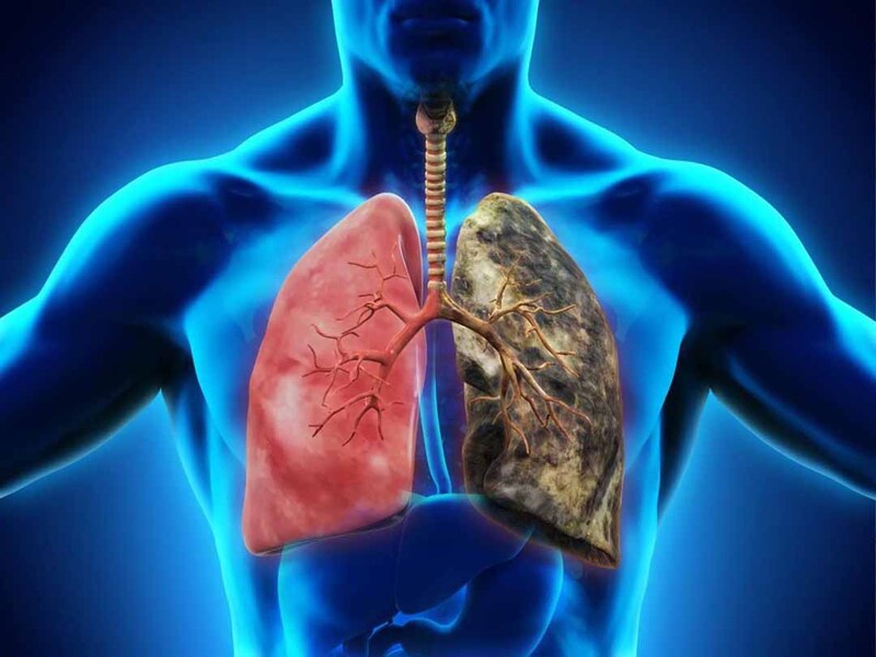 Tràn khí màng phổi áp lực là gì, biểu hiện & phương pháp chẩn đoán bệnh 3