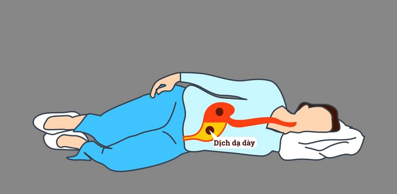 Bị trào ngược dạ dày nằm nghiêng trái hay phải tốt hơn 1