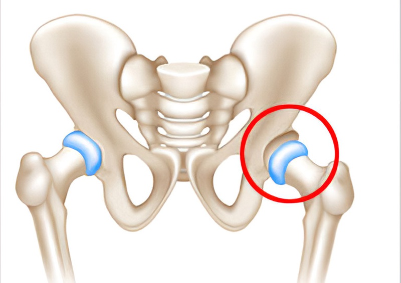 Trật khớp háng là tình trạng chỏm xương đùi khớp háng bị lệch ra khỏi vị trí bình thường