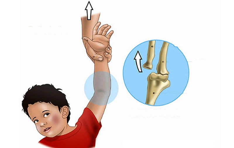 Trật khớp khuỷu tay trẻ em - Chấn thương cực kỳ nguy hiểm 2