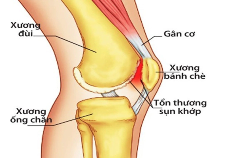 Trật xương bánh chè và những điều cần lưu ý 1