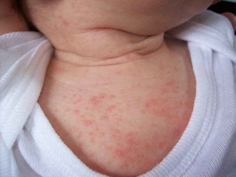 Trẻ em thường bị rôm sảy vào mùa hè