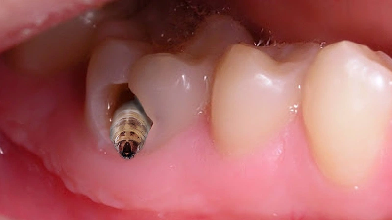 Trẻ bị sâu răng ăn vào tuỷ: Nguyên nhân, cách phòng và điều trị