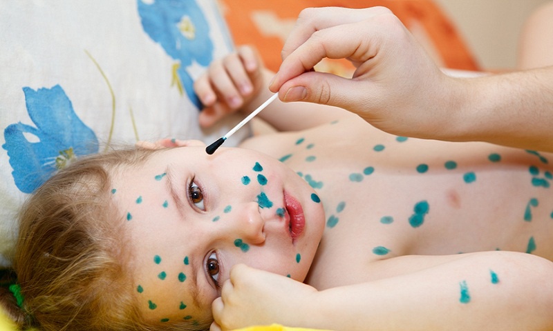 Trẻ bị thủy đậu có nên uống kháng sinh không 3