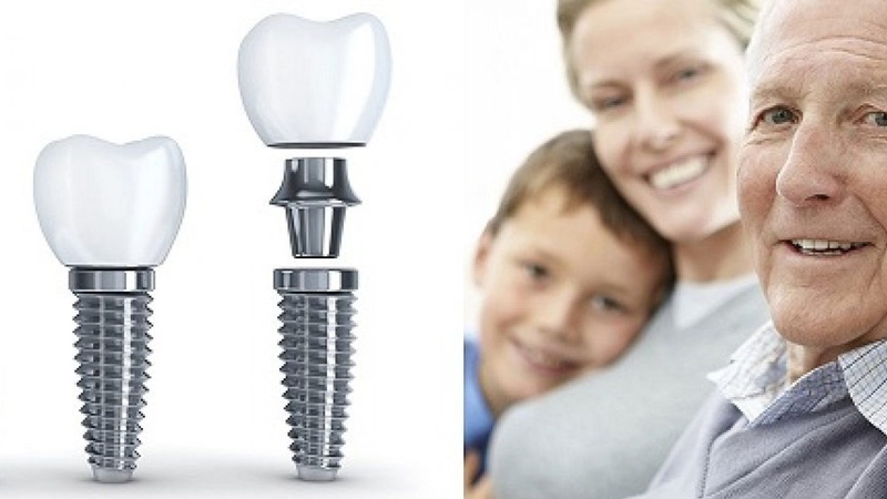 Trẻ em có trồng răng implant được không? Những lưu ý khi trẻ bị mất răng 2