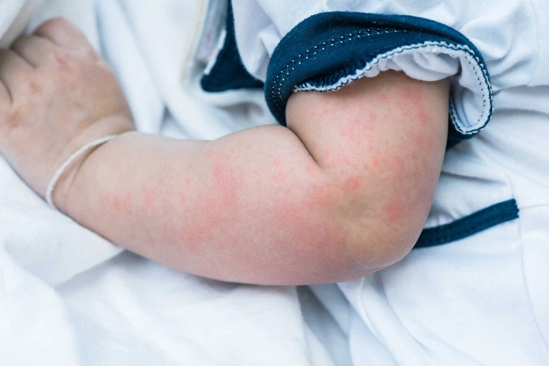 Trẻ mắc bệnh sởi phát ban có ngứa không? 3
